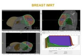 Reduction of coronary stenosis through the use of IMRT in   breast cancer