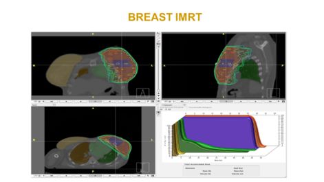 Reducci&oacute;n de las estenosis coronarias gracias al empleo de IMRT en C&aacute;ncer de Mama