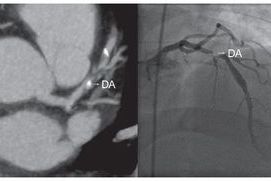  ANGIO TAC CORONARIA: Un avance en el diagnóstico cardiológico  | BCM