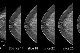 3D mammography