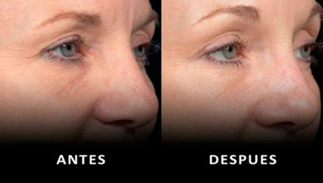 Rejuvenate the look with the Thermage method