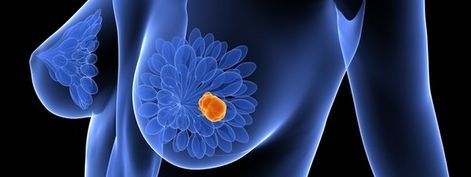 Células inmunitarias favorecen la progresión del cáncer de mama