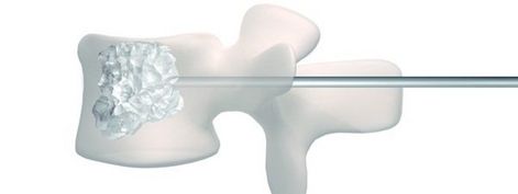 Vertebroplastia, solución al dolor de espalda 