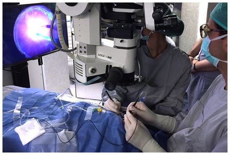 Vitreous surgery with 3D technology